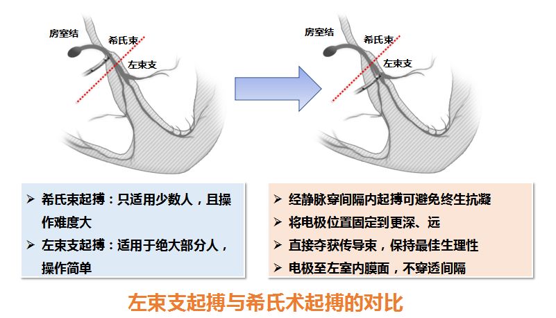 相对希氏束起搏来说,左束支区域起搏 最大的优点在于跨越阻滞部位,最