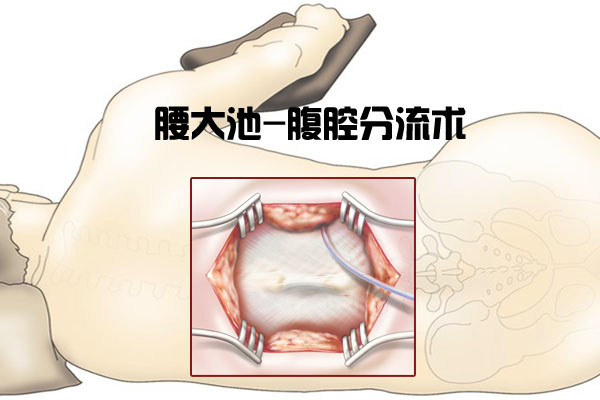 腰大池分流术图片