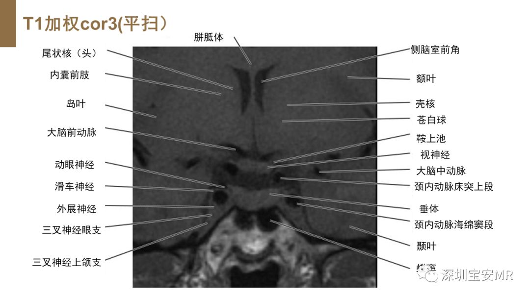 垂体解剖结构 MRI图片