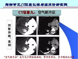 空氣新月徵曾認為是麴黴菌球的特異徵象,特點是隨著體位的變動,空洞或
