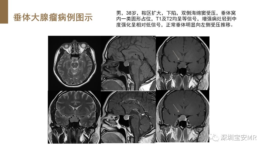 垂体磁共振影像解剖