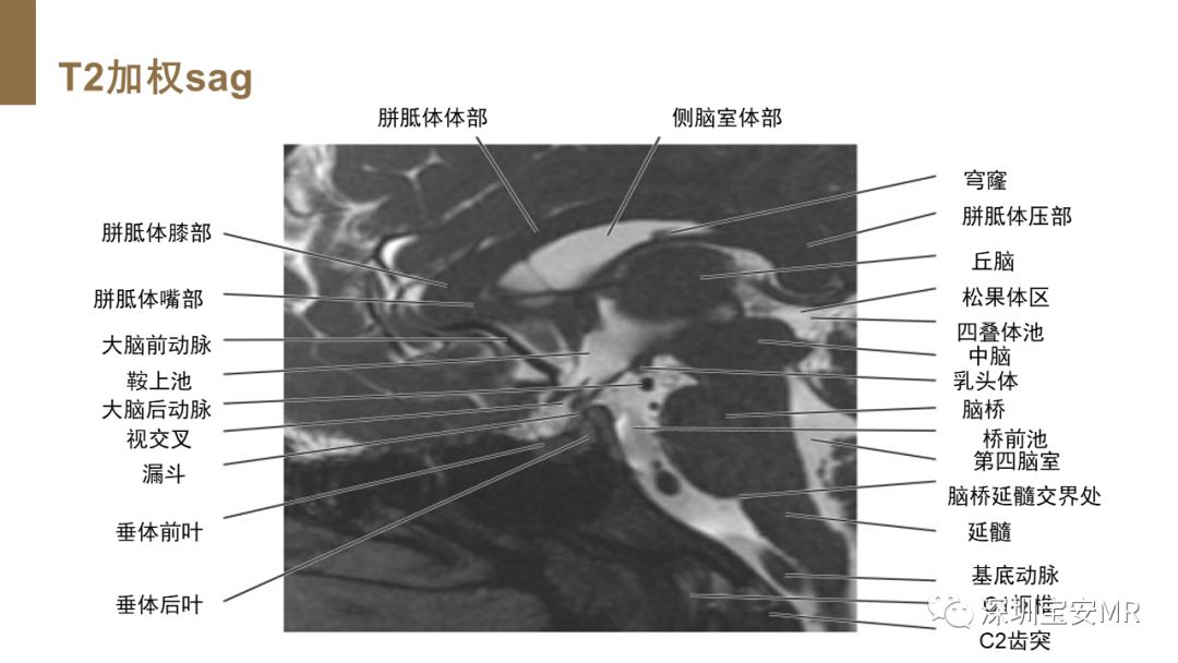 垂体横断解剖图图片