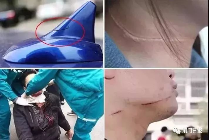 "大夫说,孩子脖子被外力划破皮流血,所幸不算深.