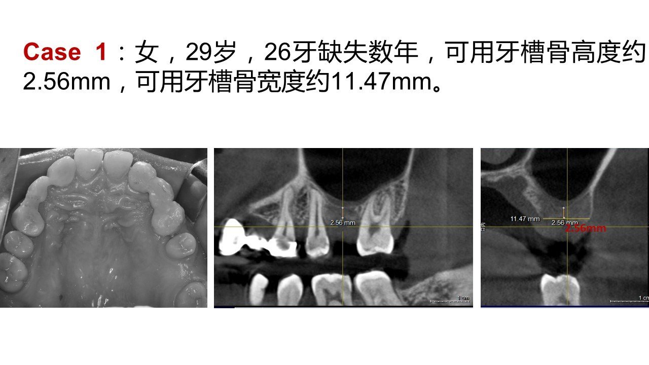 上颌后牙区骨量不足的微创种植治疗--福州种植牙医鄢明东 (原创)_附属