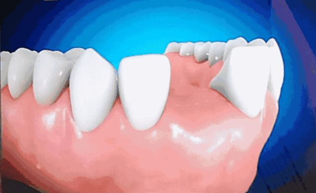 牙齿矫正,不用戴"套"!这波操作绝对让你脸红心跳!