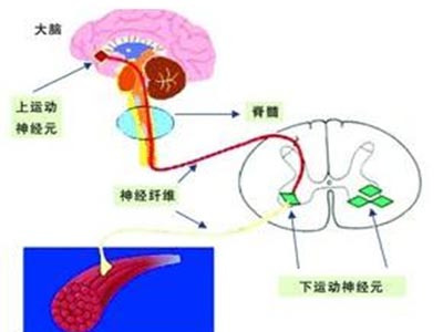 运动神经元疾病的基本常识