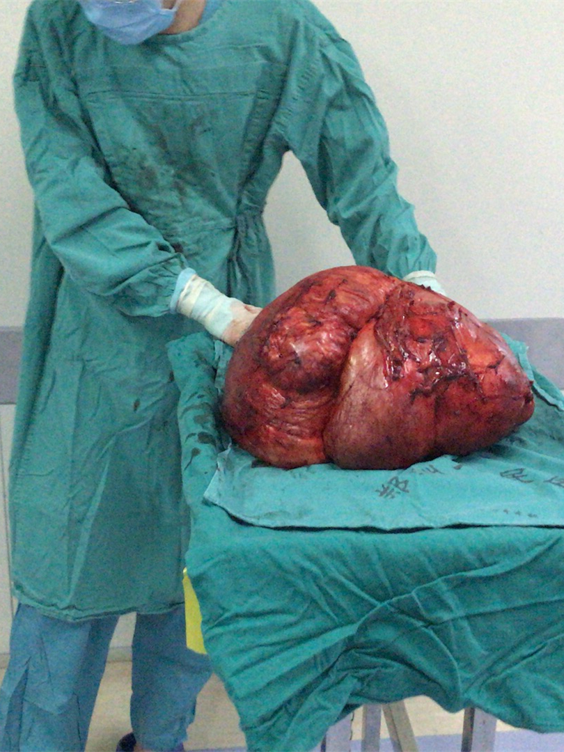 男子肚大如孕妇一朝分娩出276斤大肿瘤