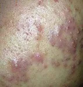 玛尚护肤|总是摆脱不掉痘痘?可能和日常饮食有关_脂肪