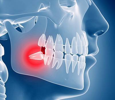 牙痛可怕,因为长智齿引发的牙痛更可怕,9成人都不了解的智齿到底是