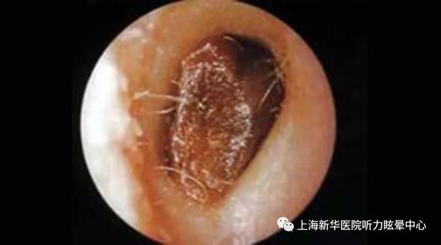 有一天耳朵暂时性失灵了这可怎么办