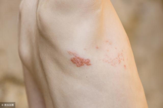 带状疱疹的临床症状有哪些?会传染吗