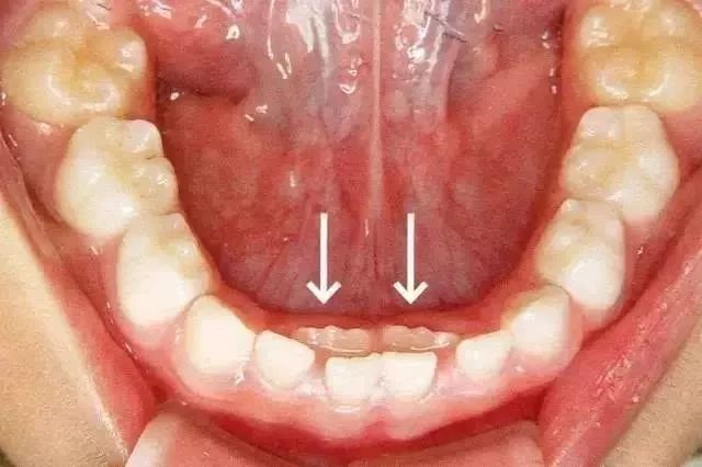 10个孩子里5个长双排牙,医生感叹:都是家长喂出来的