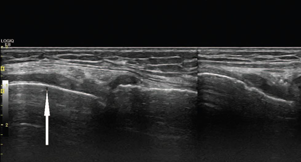 当类风湿关节炎遇到痛风会擦出怎样的火花