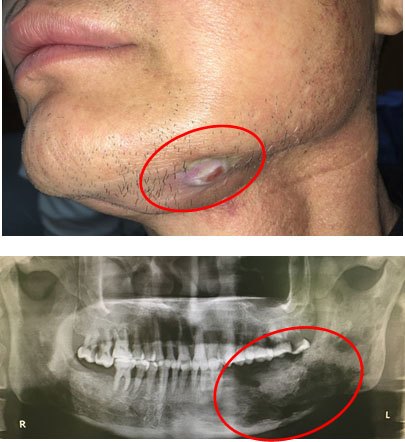 颌骨肿瘤症状图片图片