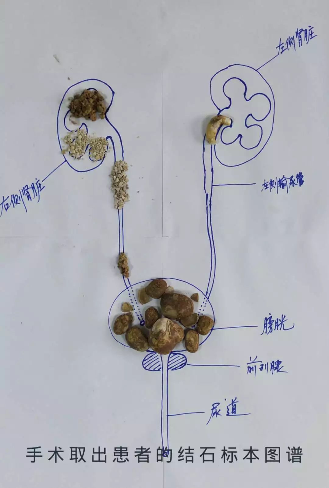 5mm肾结石有多大图片图片