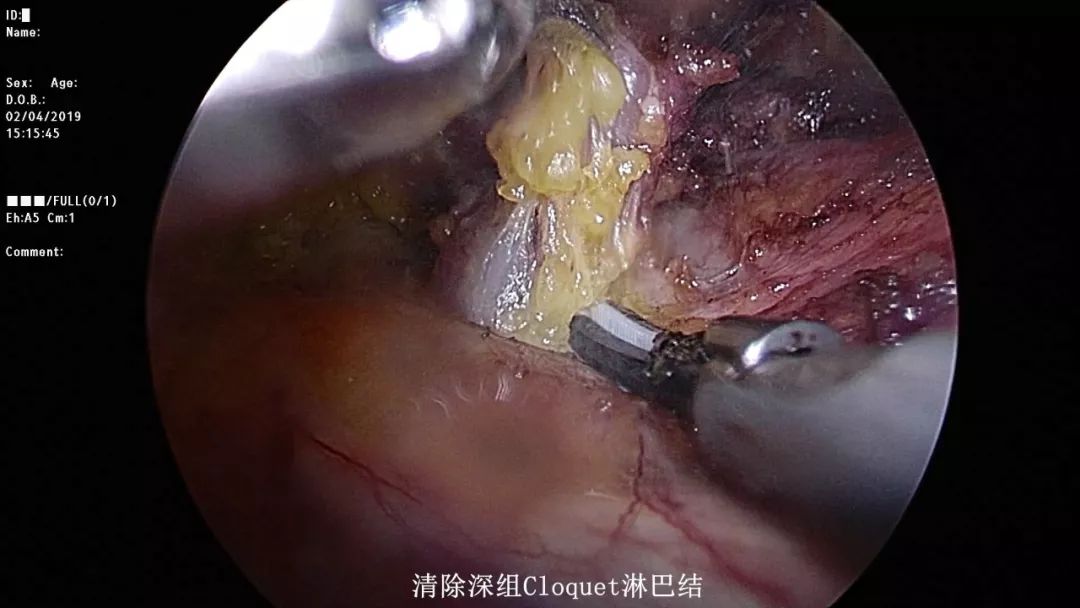 腹股沟淋巴结清扫图片