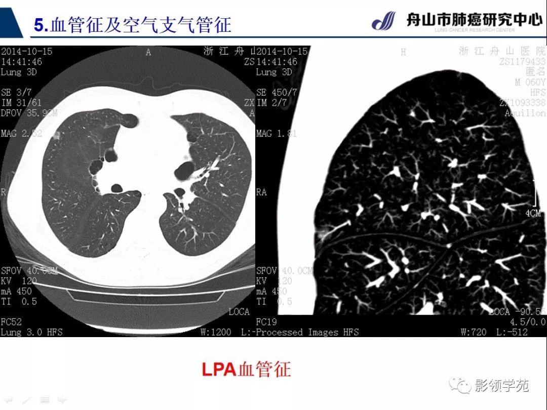 經典課堂早期周圍型肺鱗癌ct診斷及鑑別診斷下