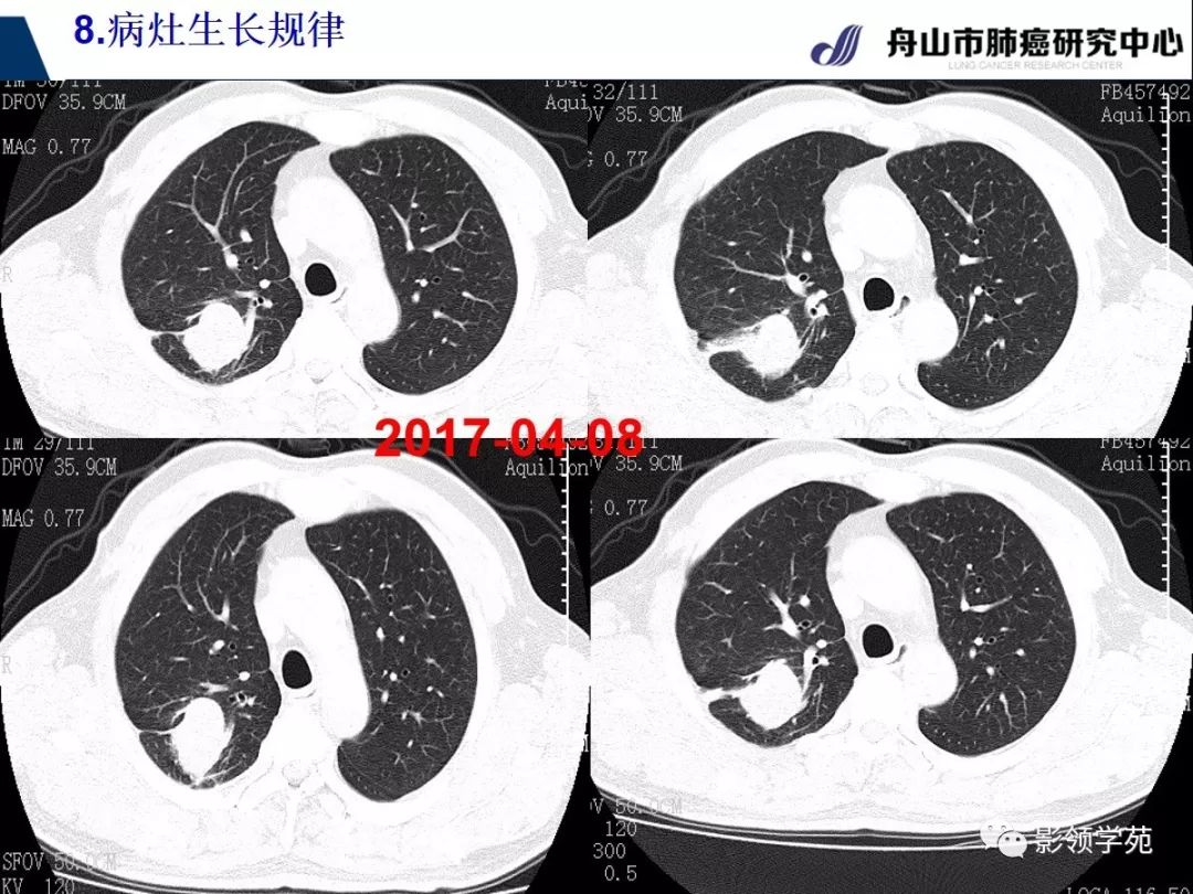 周围型肺癌CT图片