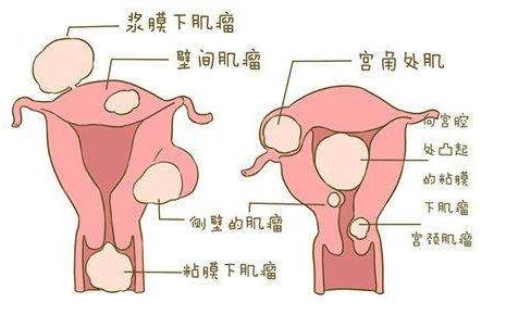 不同位置的子宫肌瘤对怀孕的影响