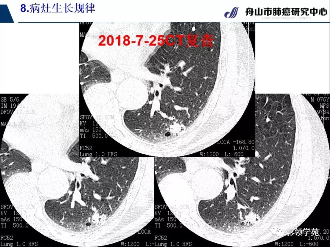 經典課堂早期周圍型肺鱗癌ct診斷及鑑別診斷下