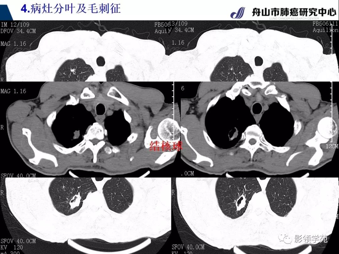 經典課堂早期周圍型肺鱗癌ct診斷及鑑別診斷下