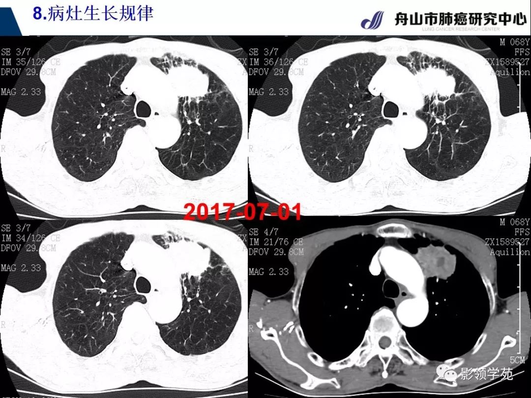 肺部肿瘤鳞状图片