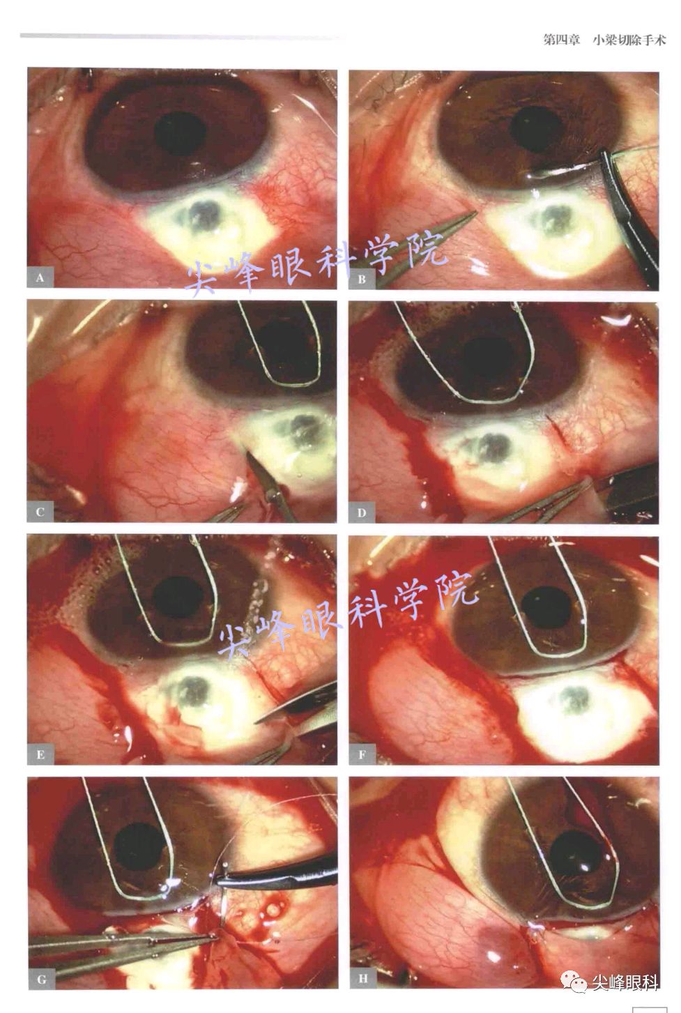 小梁切除术 后遗症图片
