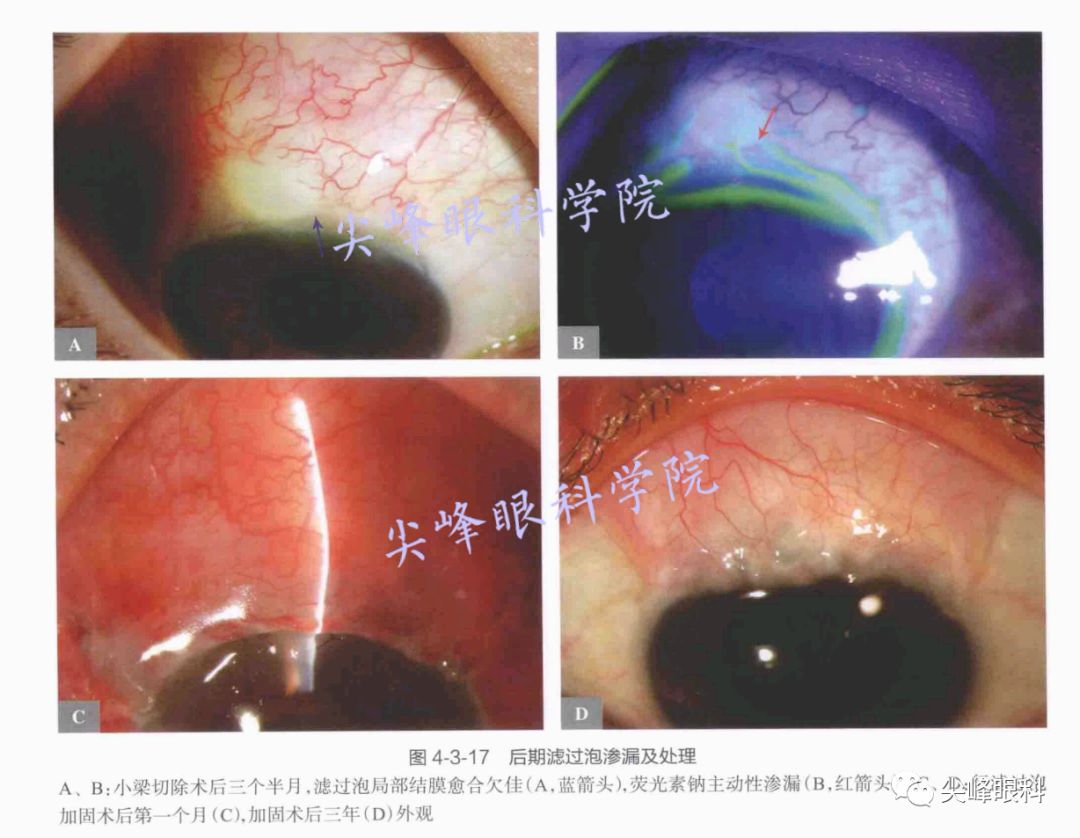 性低眼压,造成低眼压性黄斑病变,视力下降,也可导致浅前房,角膜干燥斑