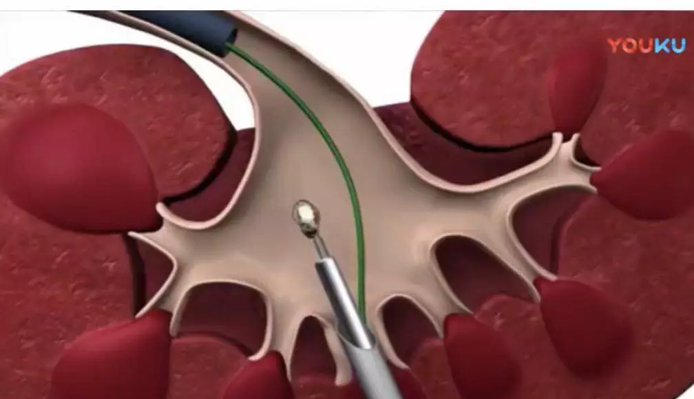 科普肾结石的治疗方法之一经皮肾镜取石手术