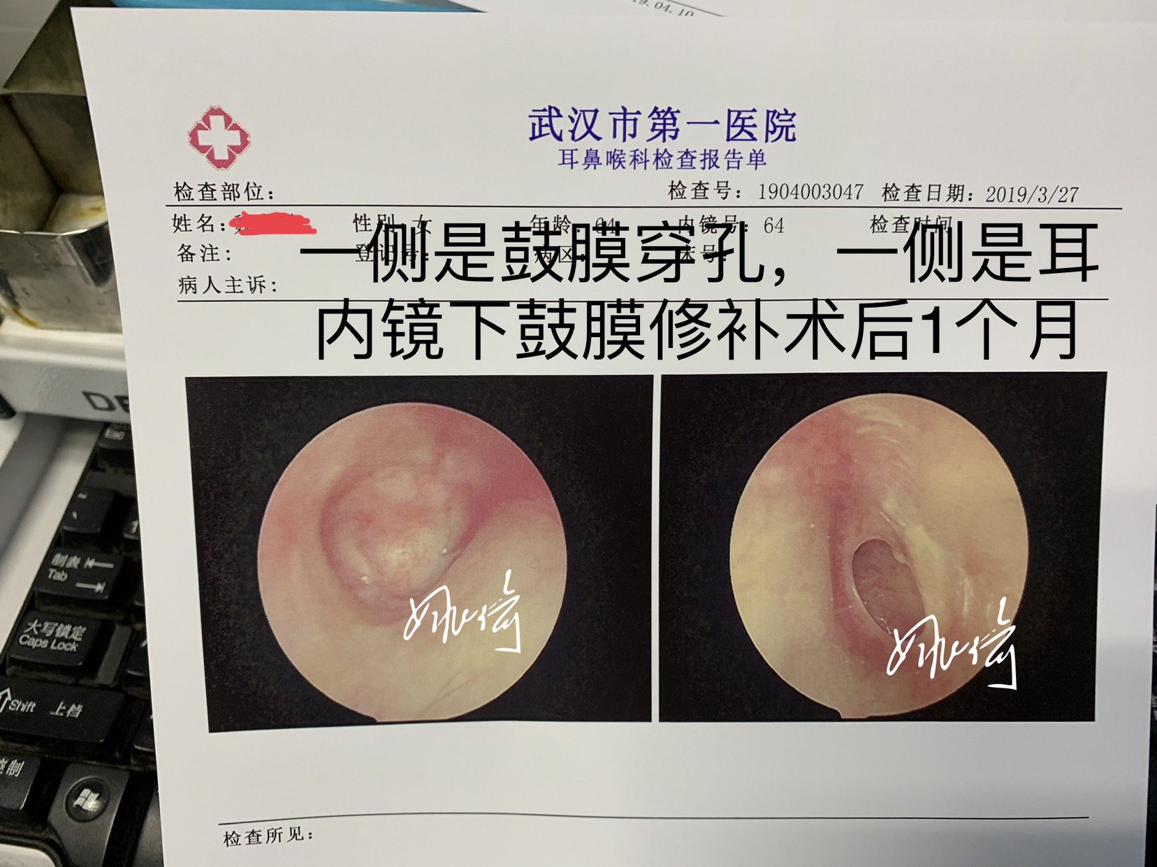 耳膜修复手术图片