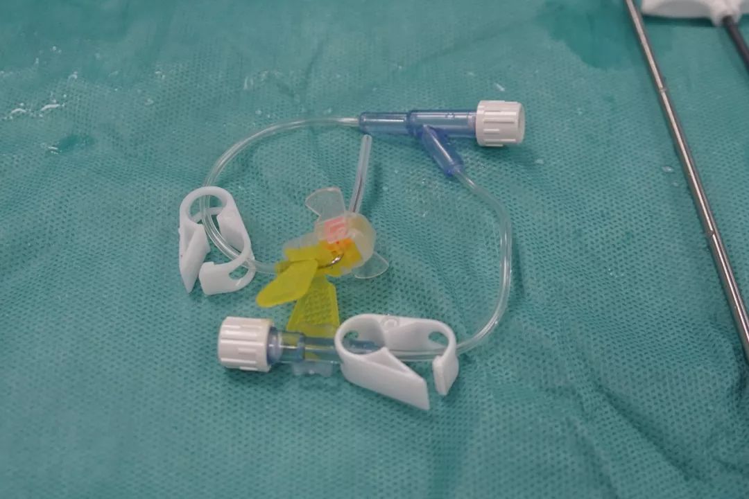 静脉输液港的植入通常在局部麻醉下,医生首先通过血管穿刺的方法,将