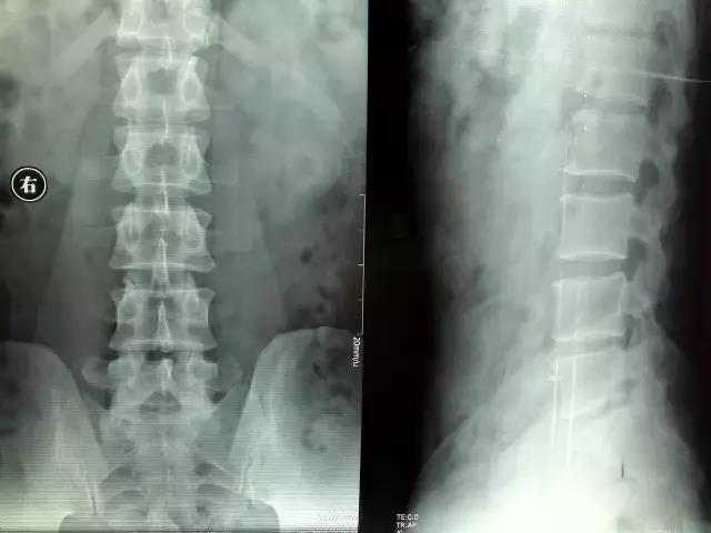 腰肌劳损x光片图片图片