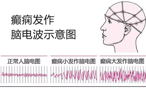 24小时立体定向脑电图seeg监测真凶现行癫痫