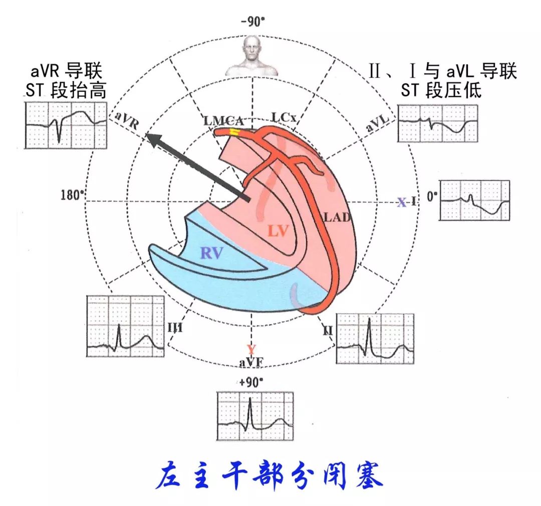 左主干心电图特点图片