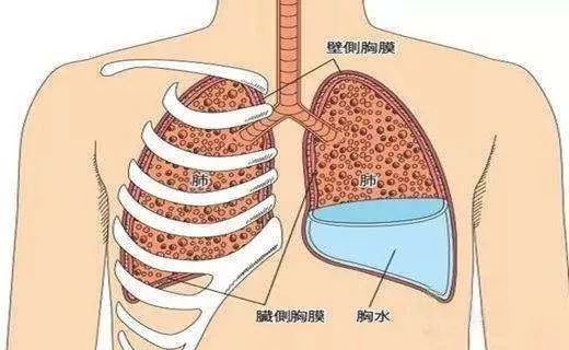 新冠肺炎的肺部图片