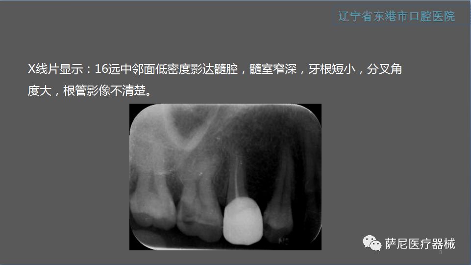 全國根管大賽一等獎東港市口腔醫院馬勇,副主任醫師