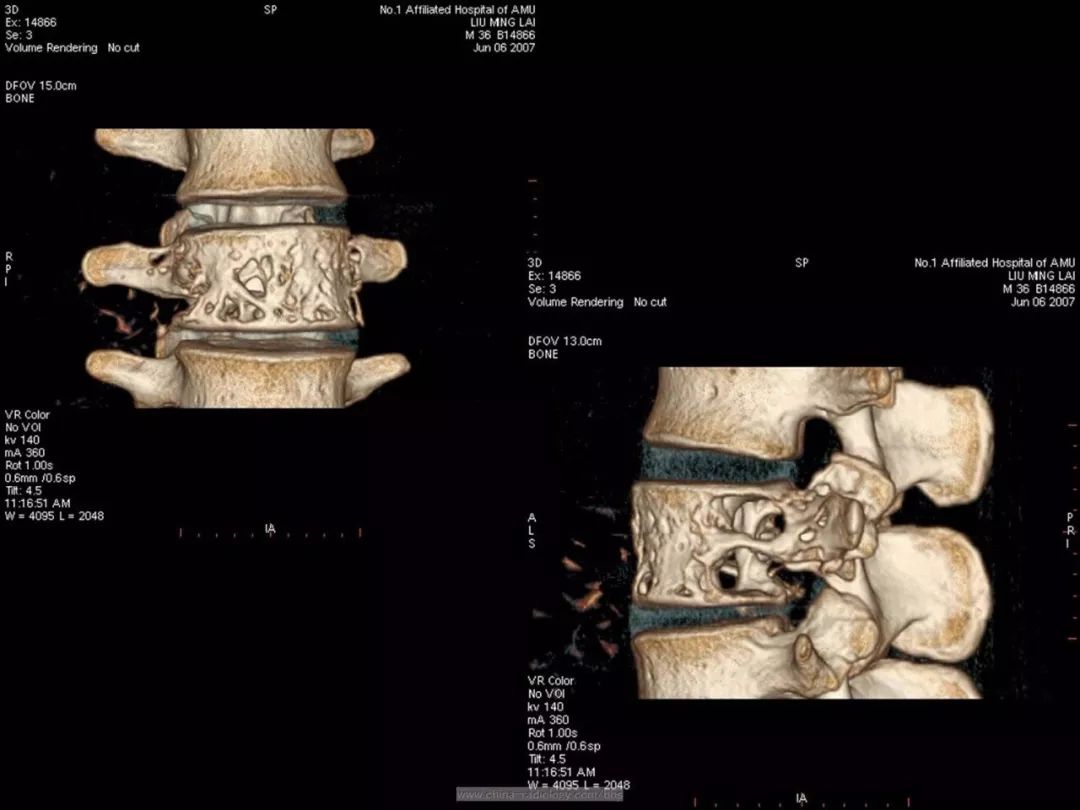 腰椎体穿凿样溶骨性破坏,等你分析 
