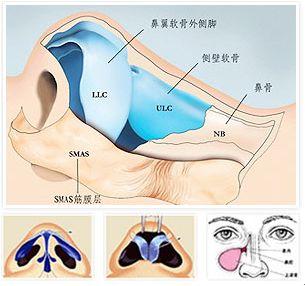 首大陈潜:鼻中隔偏曲手术矫正方法了解一下