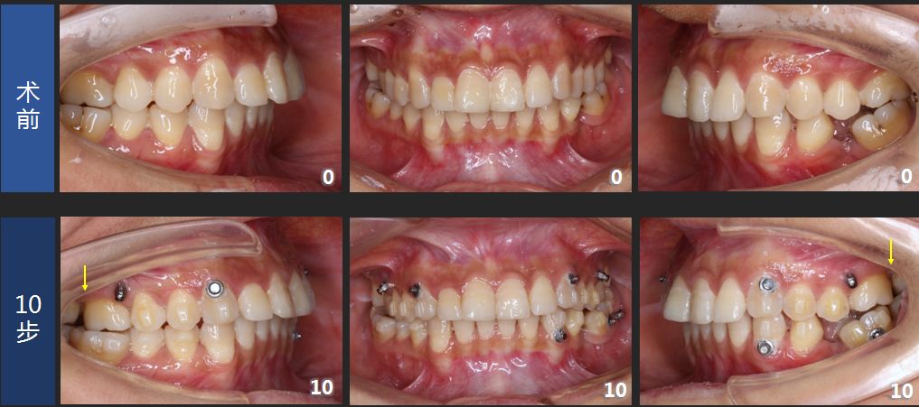 隐形矫治十强病例丨远移磨牙矫治成人安氏ii类深覆盖伴牙缺失病例