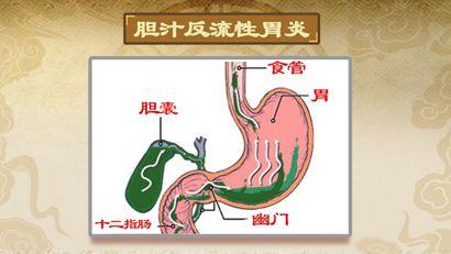 這是因為膽在添亂,膽汁由肝臟分泌,通過膽管流入十二指腸,正常應該