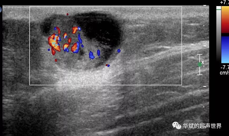 【基础】超声之浅表组织肿瘤_肿物