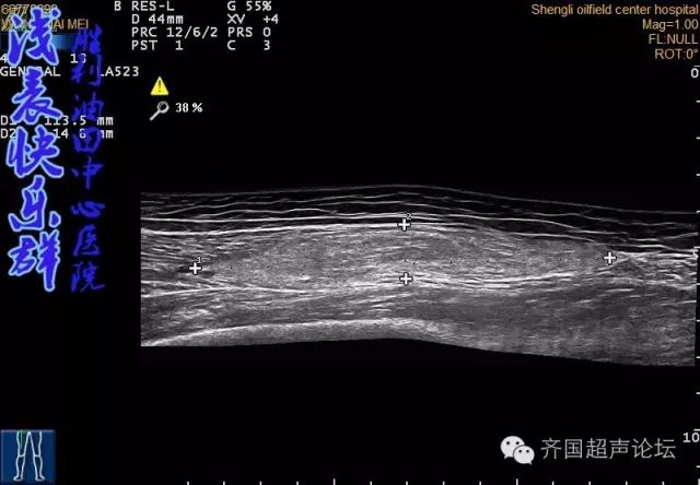 【基础】超声之浅表组织肿瘤_肿物