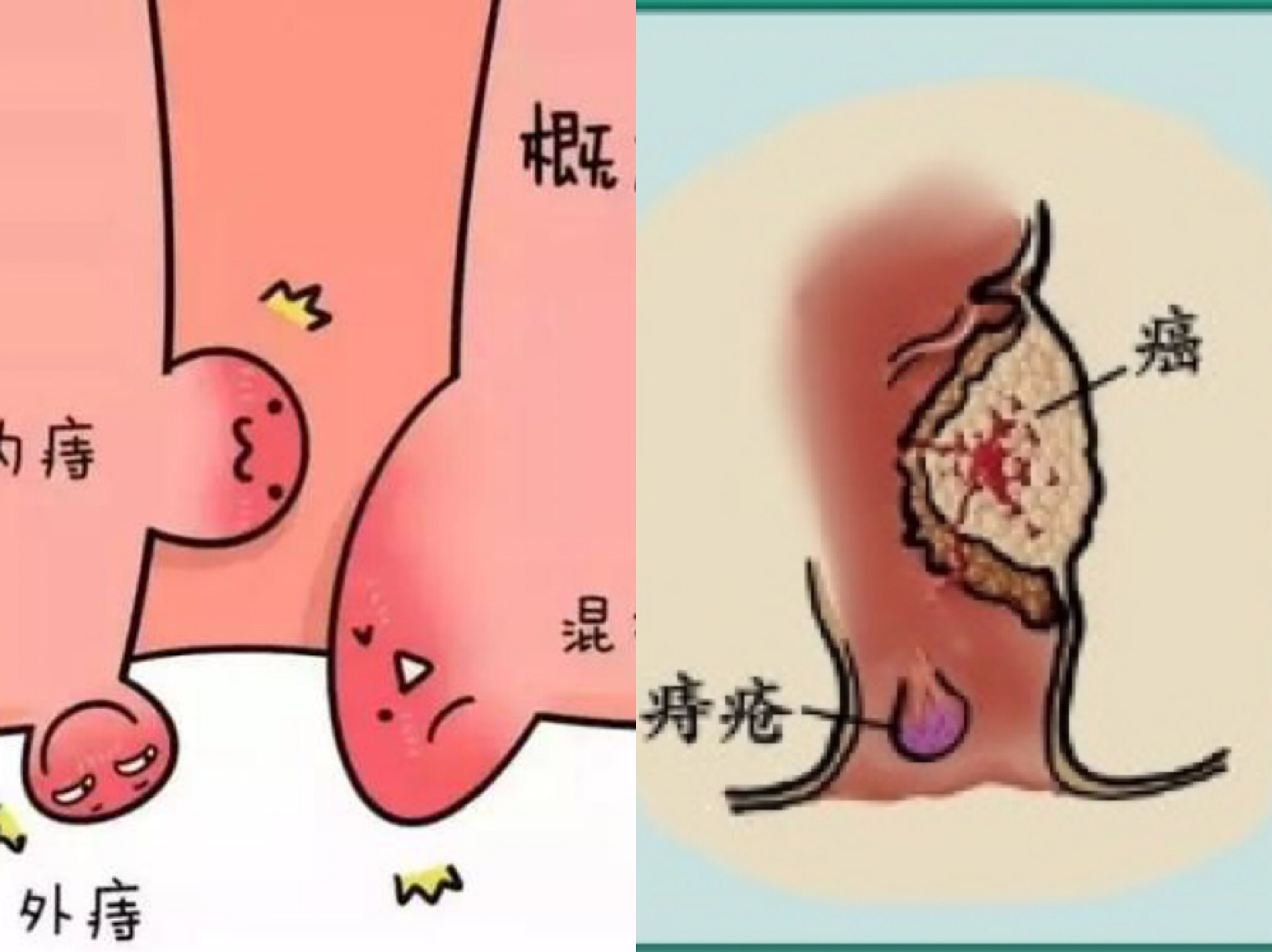 直肠癌肛门图片 肠道图片