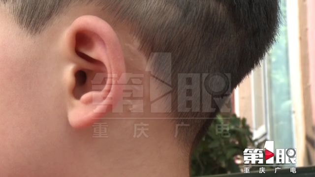 人工耳蝸遺失在壹江城正門家長急尋