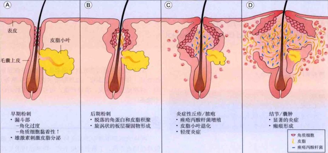 2,毛囊皮脂腺导管角化异常1,雄激素导致的脂质过量分泌