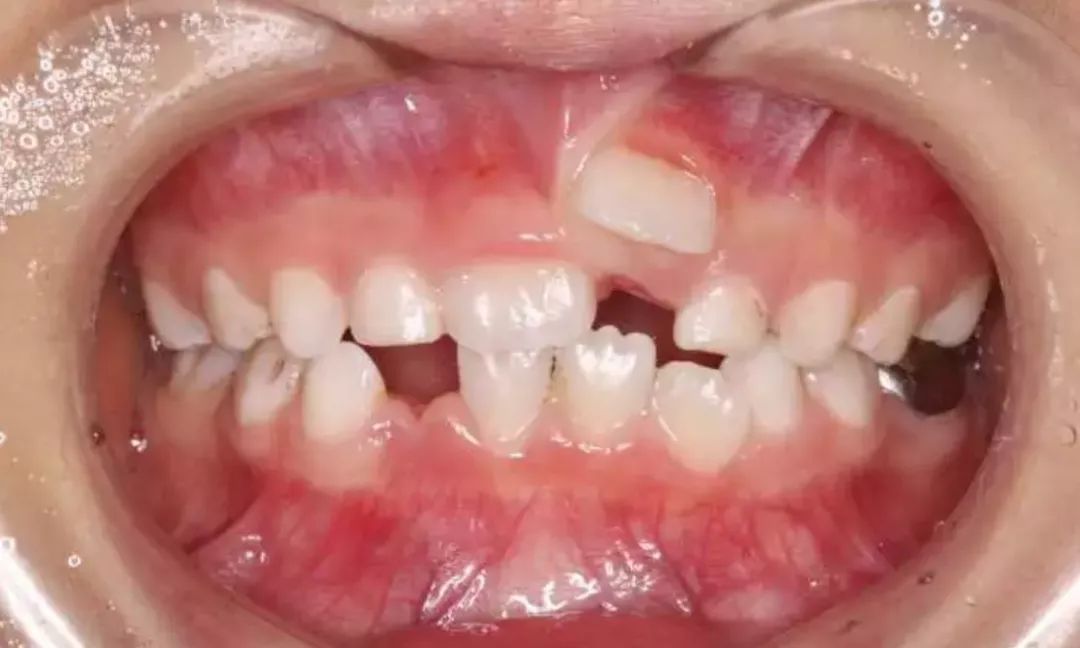 医生则表示,双排牙已成了儿童口腔疾病的常见病之一,大概要占到儿童