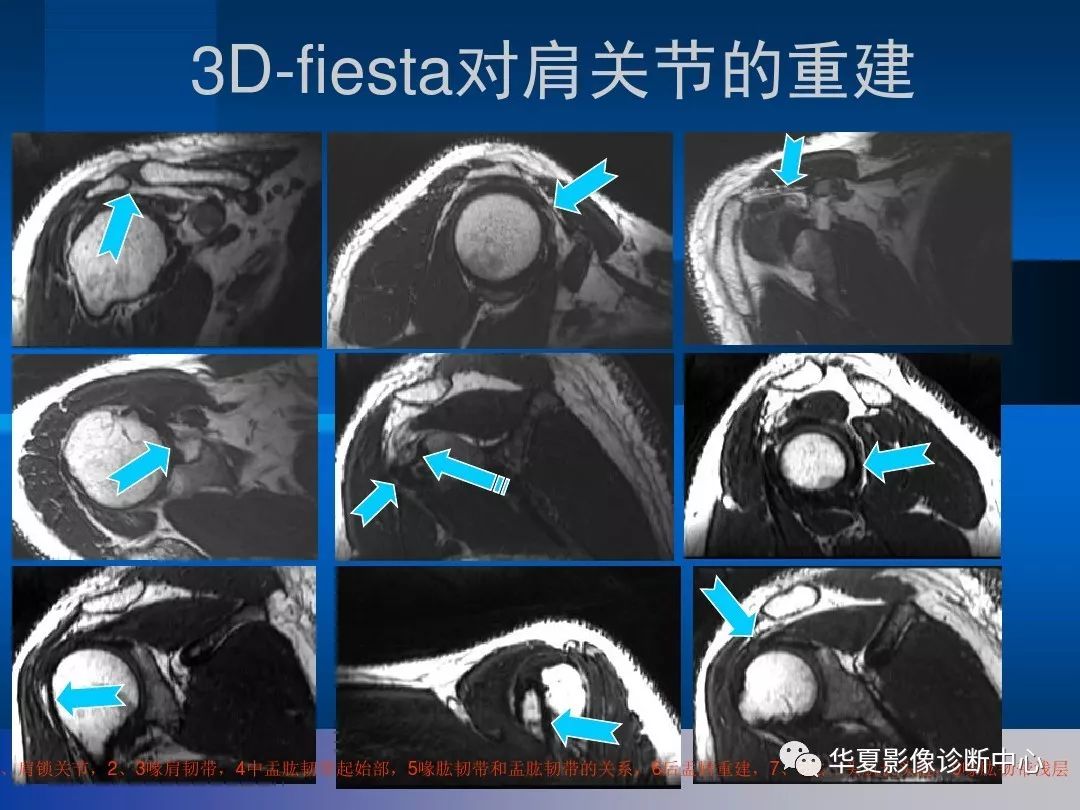 影像基礎肩關節的影像解剖與mri附關節實物圖