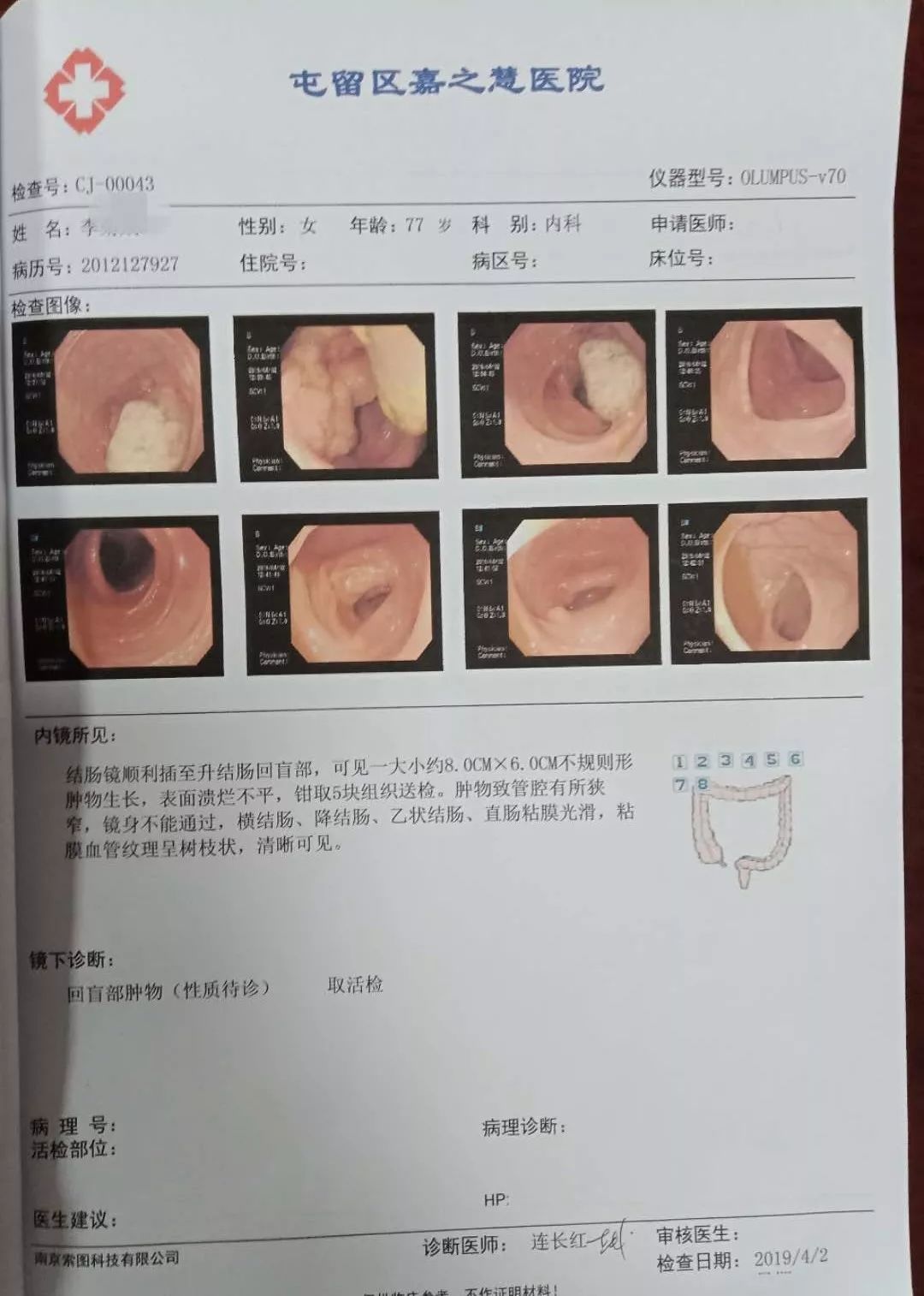 肠镜检查范围图片