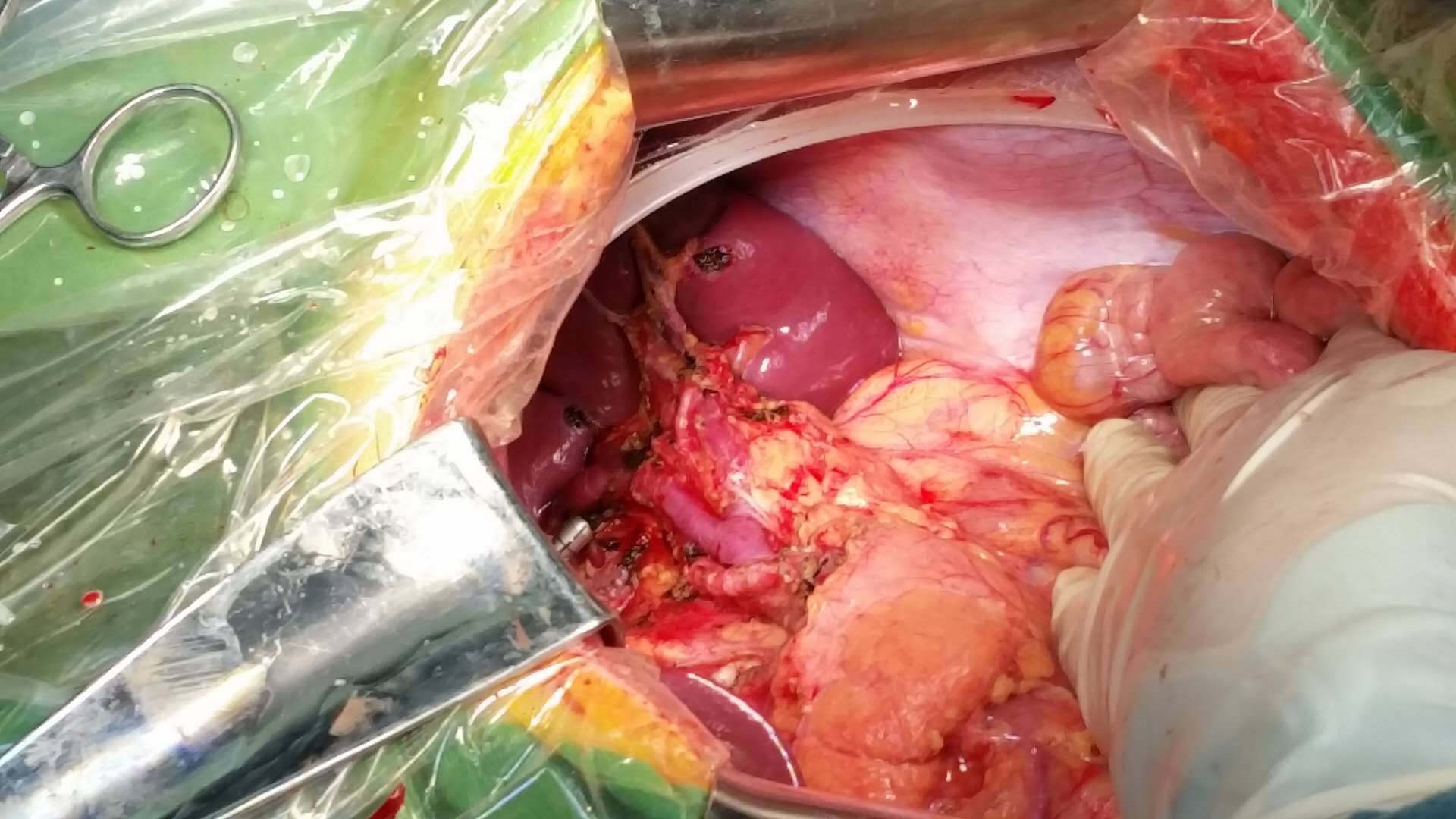 胃腺癌图片图片