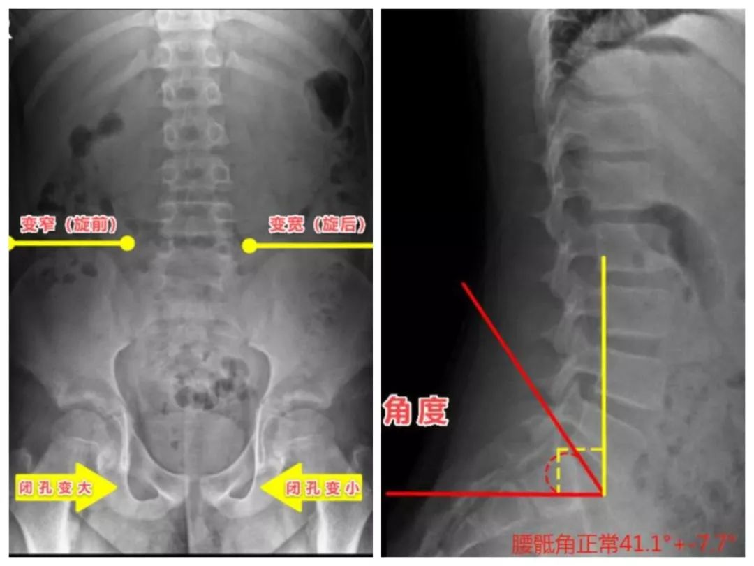 最新案例:膝痛為何不治膝,卻要調整骨盆和腰椎?